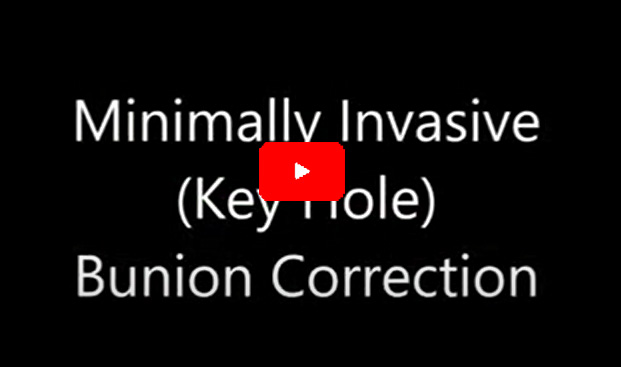 Minimally Invasive Keyhole Bunion Surgery - The Bunion Doctor - UK's Leading Keyhole Bunion Expert